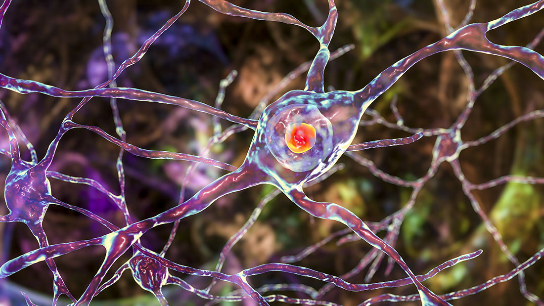 3D illustration of neuronal intranuclear inclusion